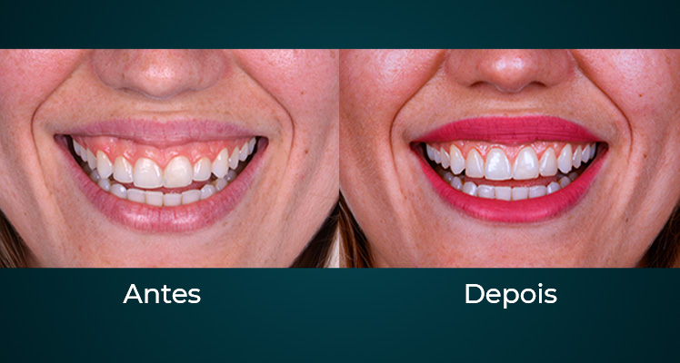 Gengivoplastia / Gengivectomia